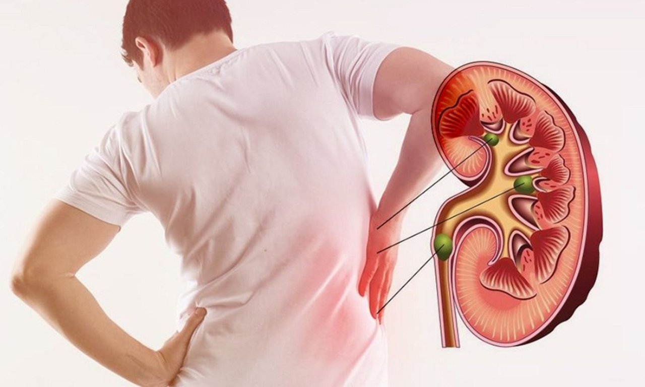 Bệnh nang thận là gì? Nguyên nhân, triệu chứng, chẩn đoán và cách điều trị