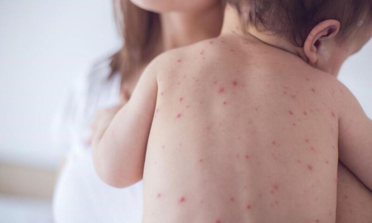 banner thủy đậu lây qua đường nào