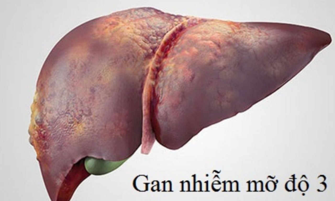 Gan nhiễm mỡ cấp độ 3: Nguyên nhân, dấu hiệu và cách điều trị
