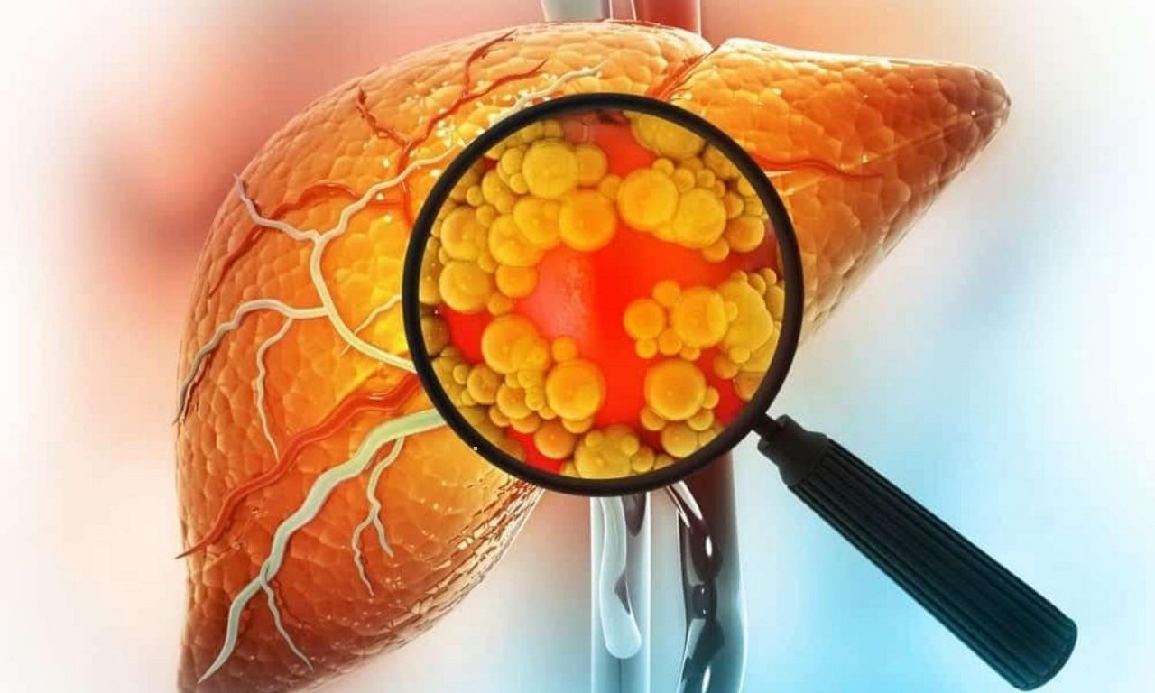 Gan nhiễm mỡ độ 1: Nguyên nhân, triệu chứng và cách điều trị