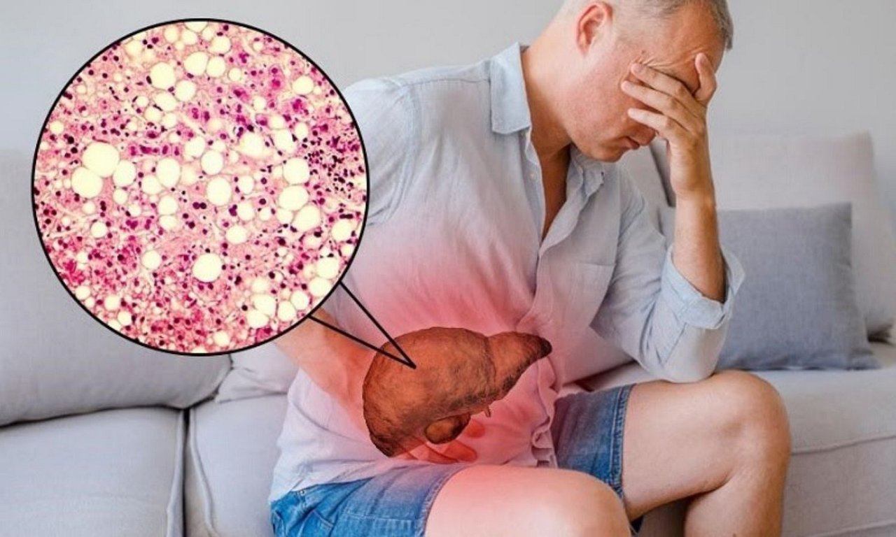 Men gan cao có nguy hiểm không? Nguyên nhân và cách khắc phục