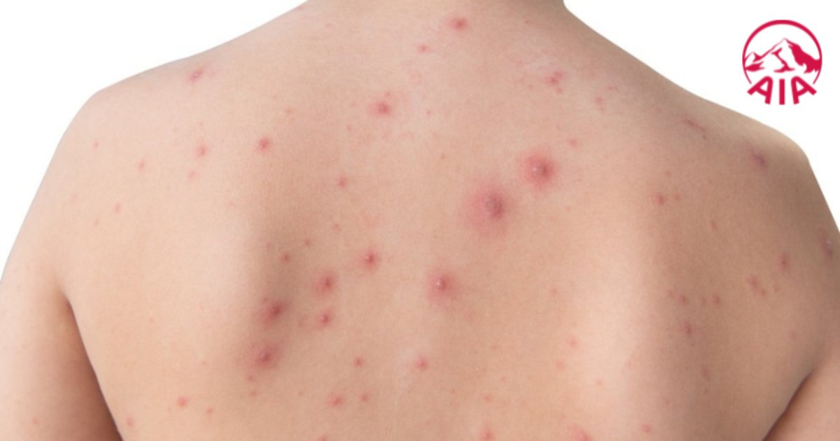 Các nốt mụn nước gây ngứa xuất hiện khi bị thuỷ đậu