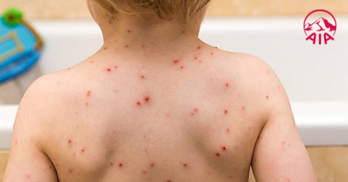 Thuỷ đậu có tốc độ lây lan nhanh chóng nên rất dễ bùng phát thành dịch
