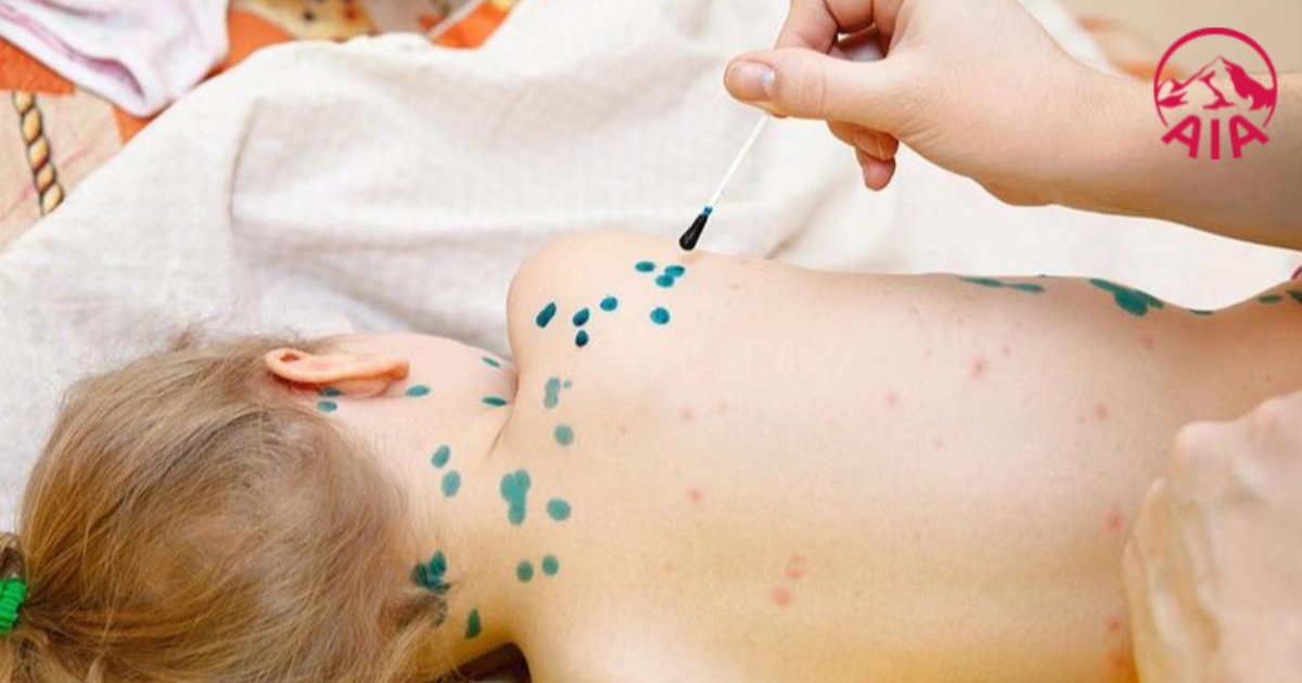 Một người sẽ chỉ bị thuỷ đậu một lần trong đời 