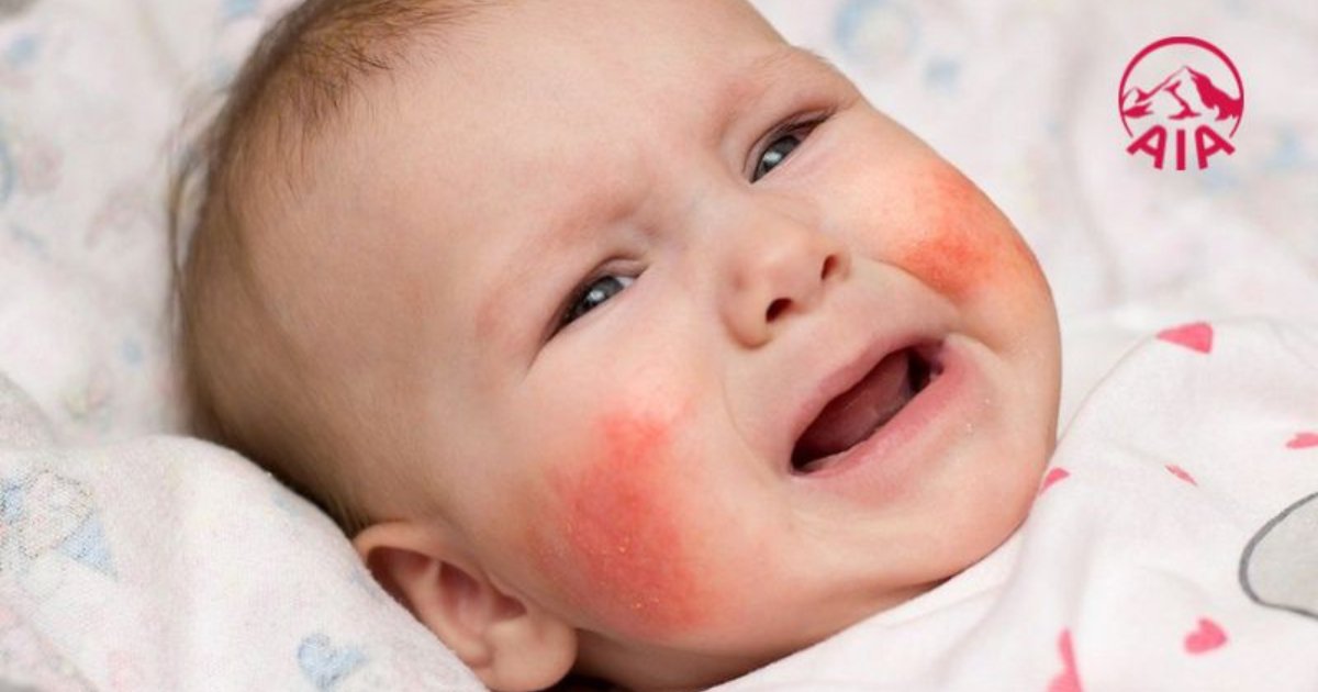 Các cách xử lý khi bị mẩn đỏ khắp người