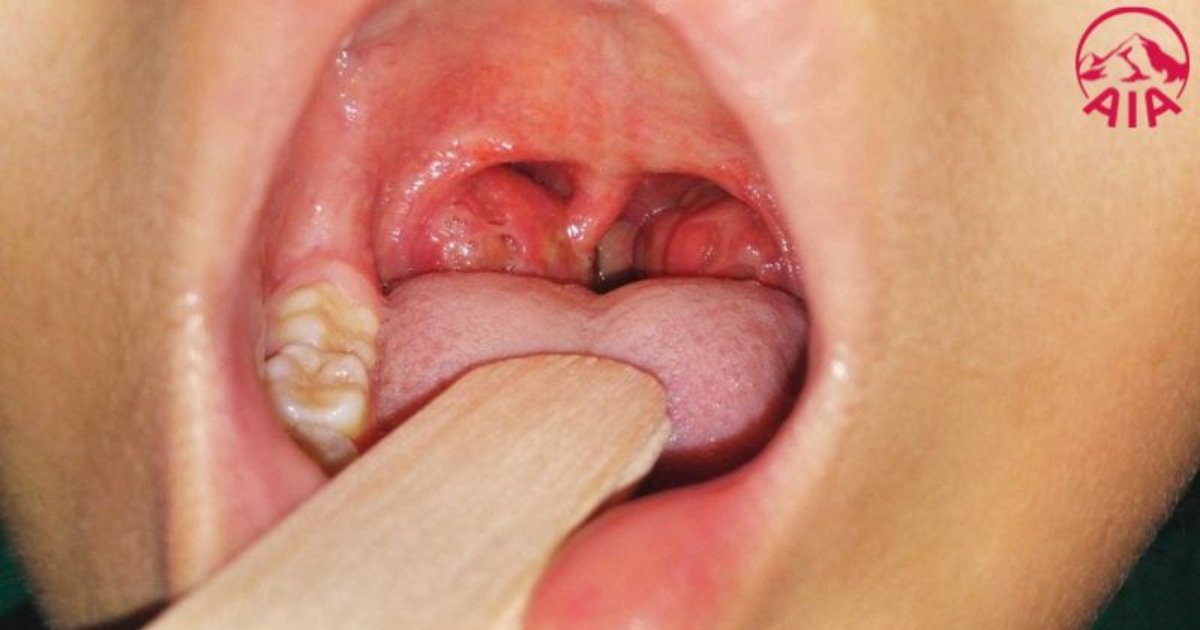 Cổ họng bị sưng khó nuốt là dấu hiệu của rất nhiều căn bệnh nghiêm trọng