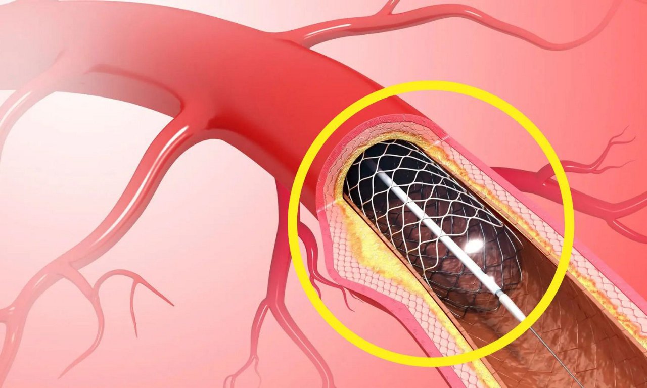 Đặt stent mạch vành có được bảo hiểm không là câu hỏi được nhiều người quan tâm