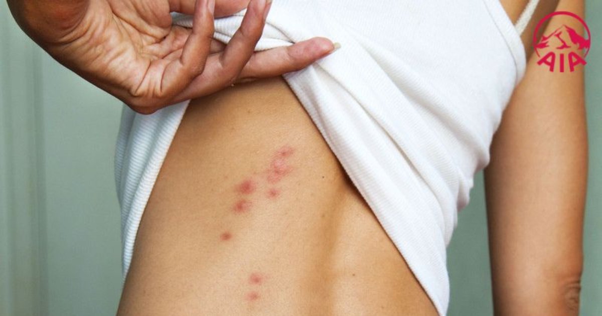 Sốt xuất huyết ở người lớn