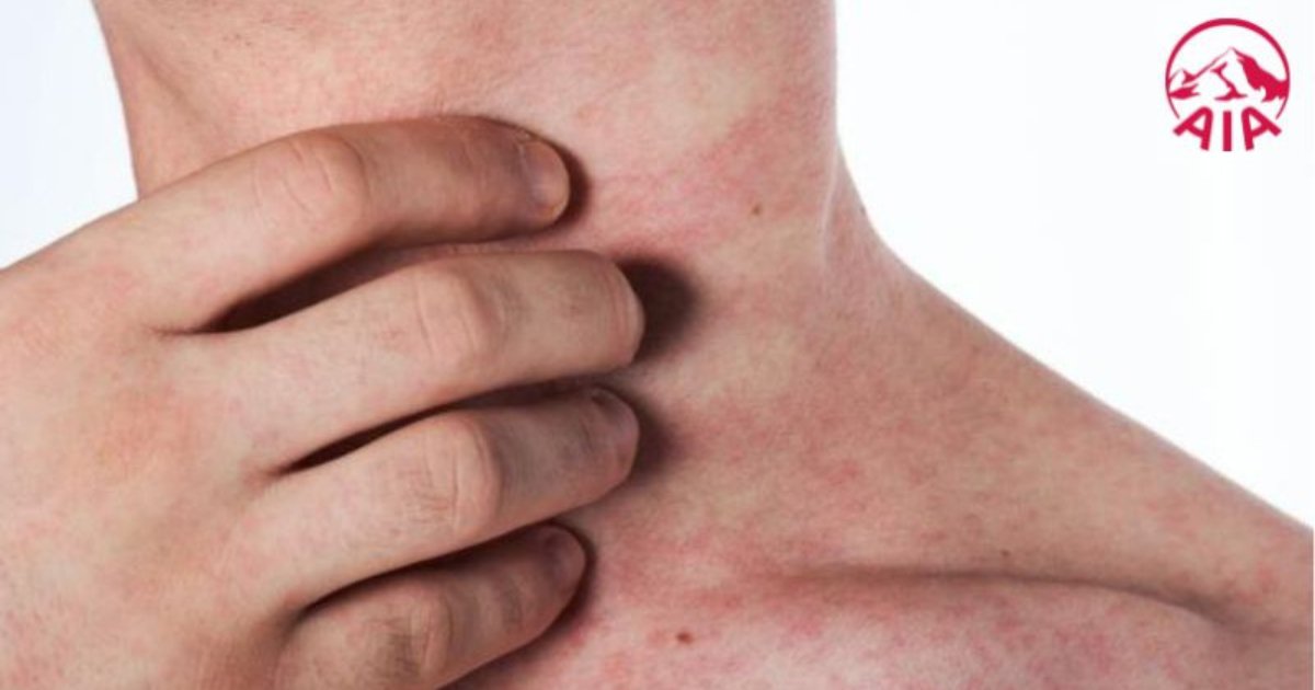Dấu hiệu cho biết bệnh nhân sốt xuất huyết cần nhập viện để điều trị