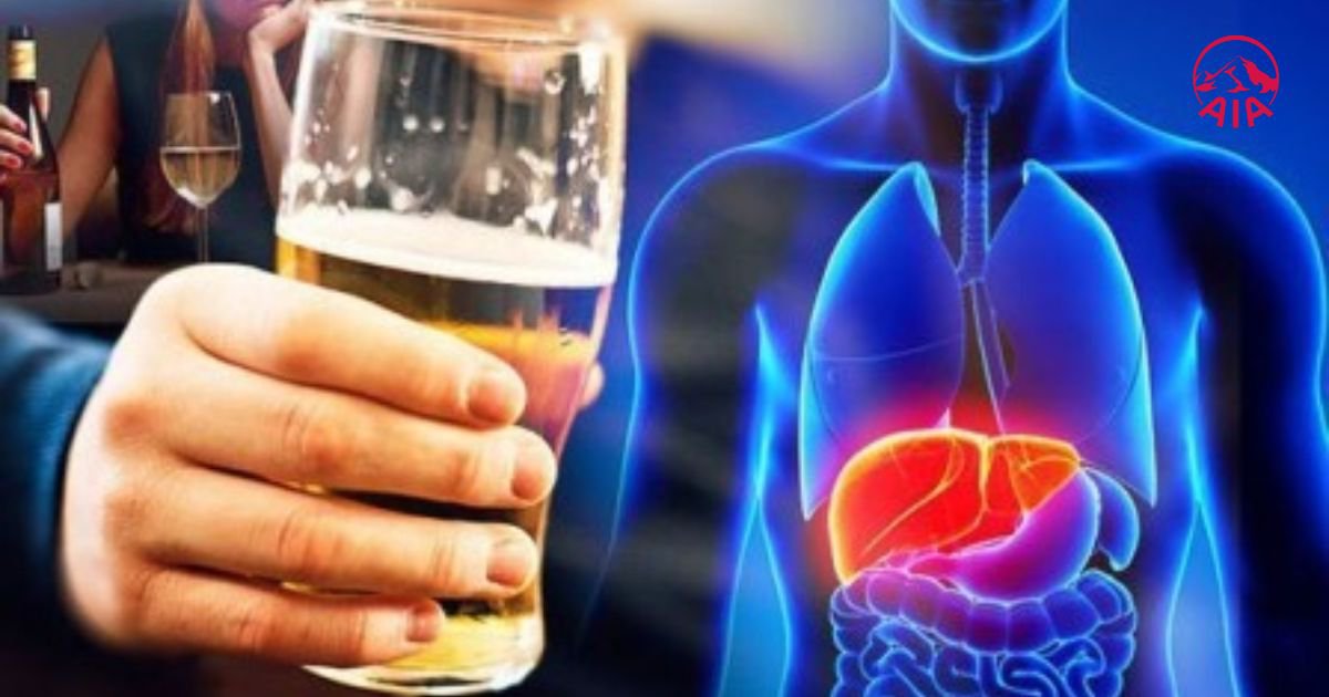 Gan nhiễm mỡ độ 1 do thường xuyên sử dụng rượu bia