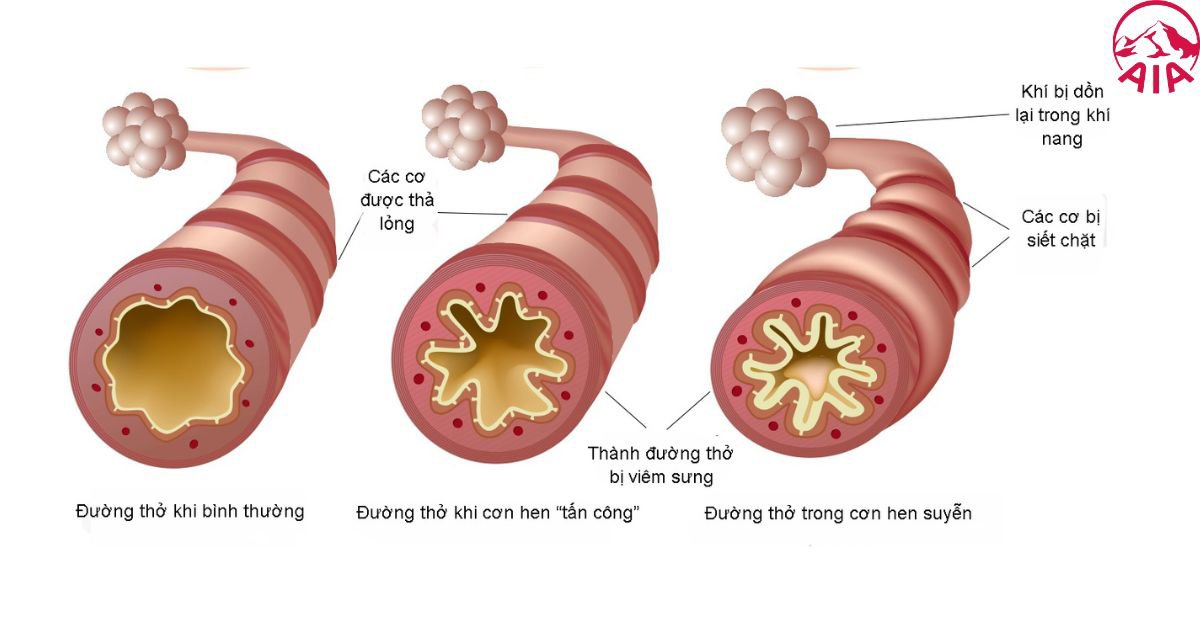 Nguyên nhân và cơ chế của bệnh hen suyễn