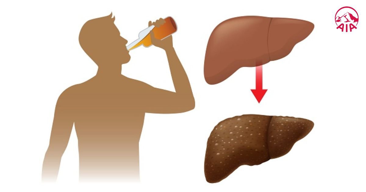 Men gan cao một phần là do uống rượu bia thường xuyên
