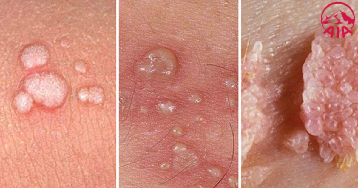 Mụn cóc sinh dục