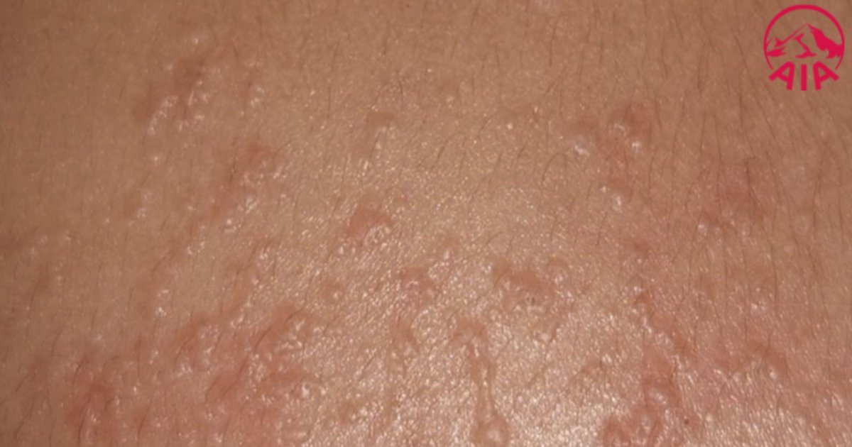 Mụn cóc phẳng