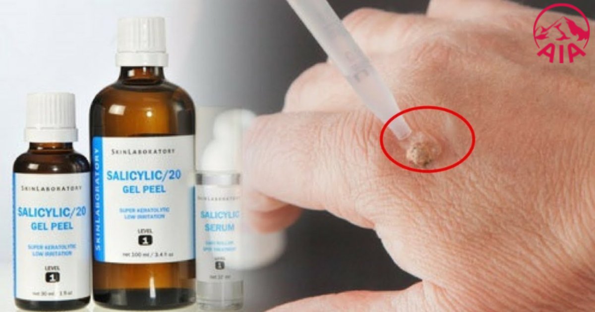 Sử dụng salicylic axit để điều trị mụn cóc