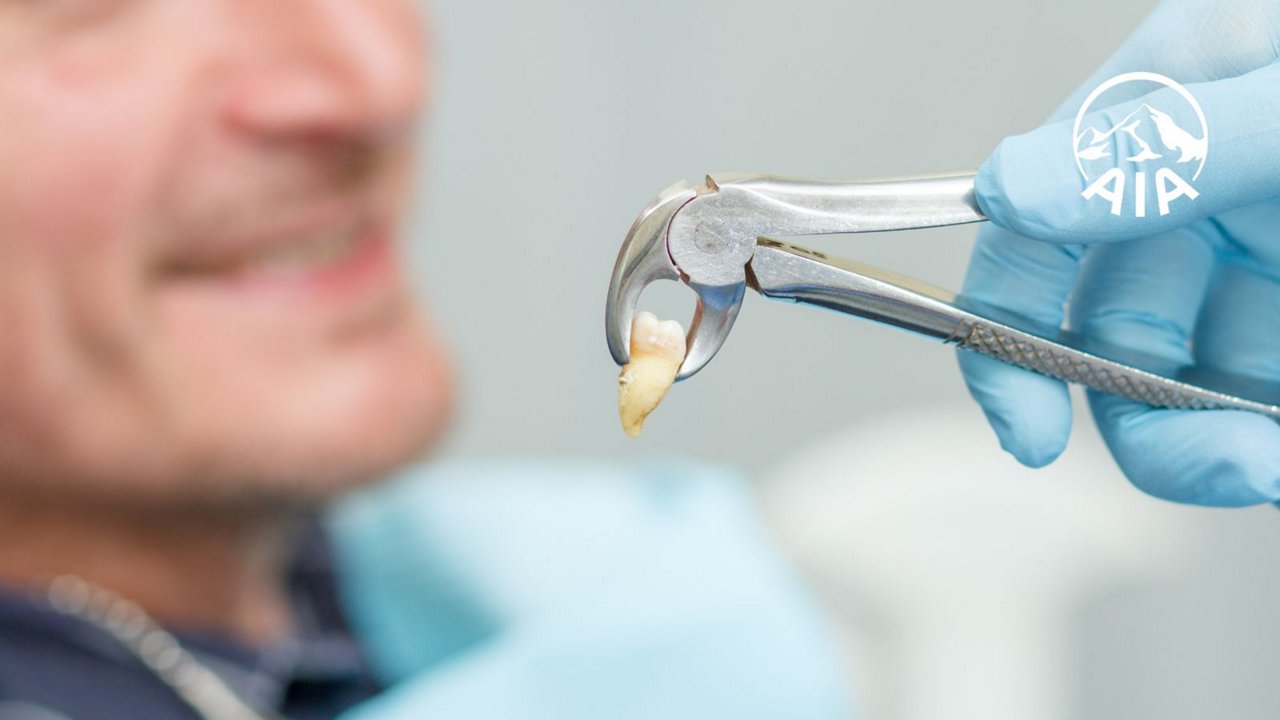 Mức hưởng của bảo hiểm nhân thọ khi nhổ răng khôn là bao nhiêu