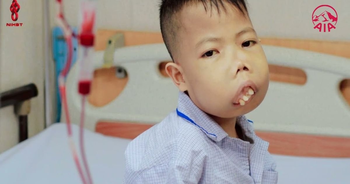 Hình ảnh trẻ bị biến chứng do tan máu bẩm sinh