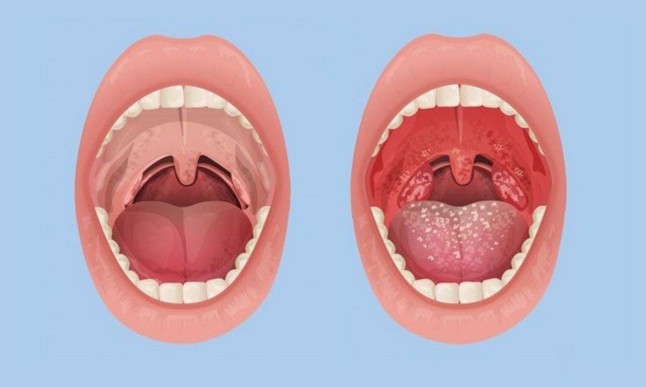 banner cổ họng bị sưng khó nuốt