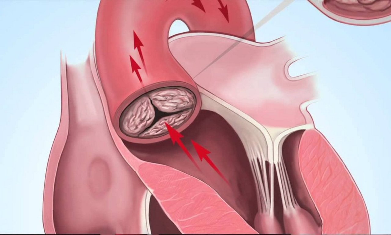 Vôi hóa mạch vành là gì? Những thông tin cần biết về vôi hóa mạch vành