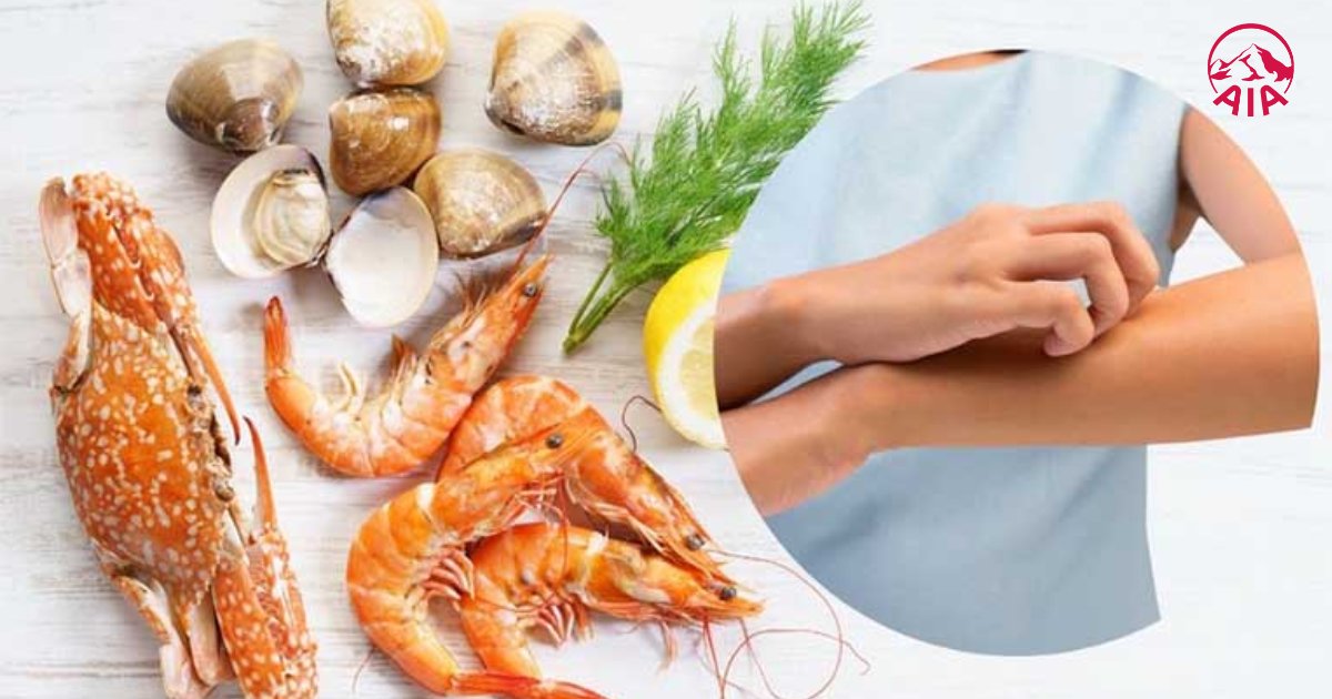 Ăn quá nhiều tôm cua có thể bị dị ứng hoặc sốc phản vệ