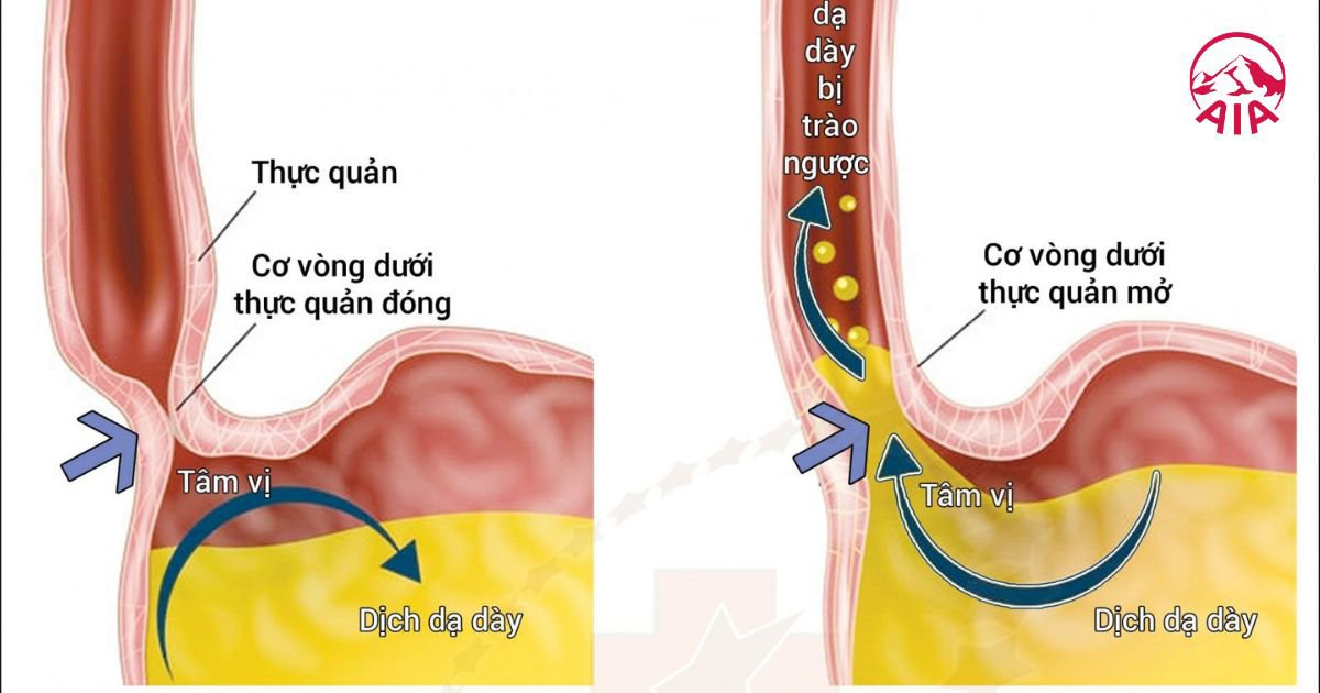 Trào ngược dạ dày là gì?