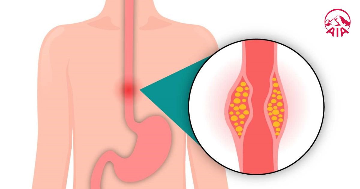 Trào ngược dạ dày có nguy hiểm không?