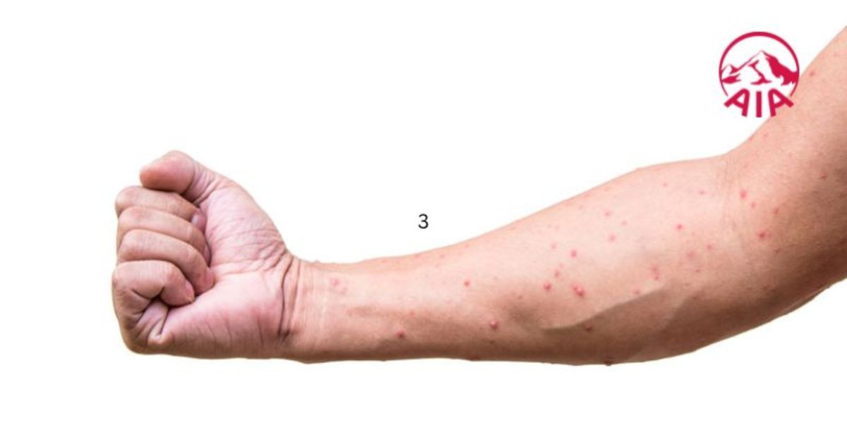 Thủy đậu là do virus Varicella gây nên.