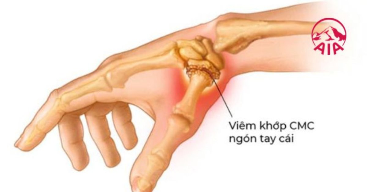 Viêm khớp ngón tay cái là gì?