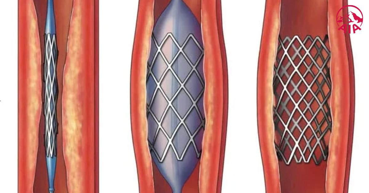 Biện pháp nong và đặt stent mạch vành