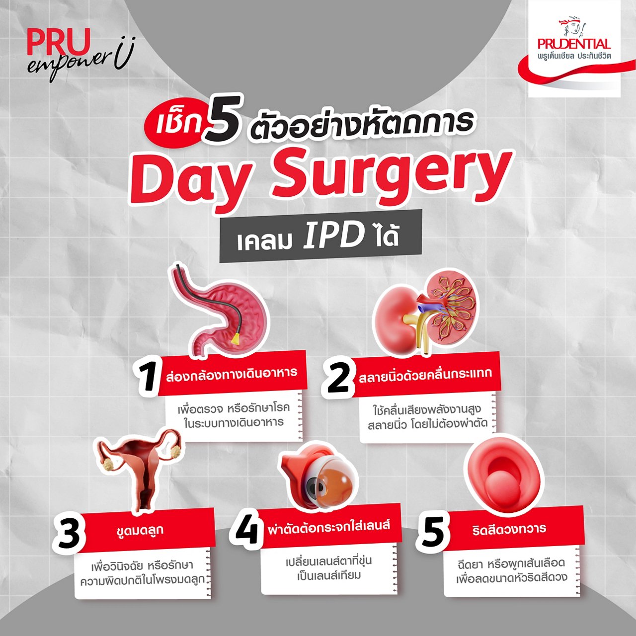 5 ตัวอย่างหัตถการ Day Surgery