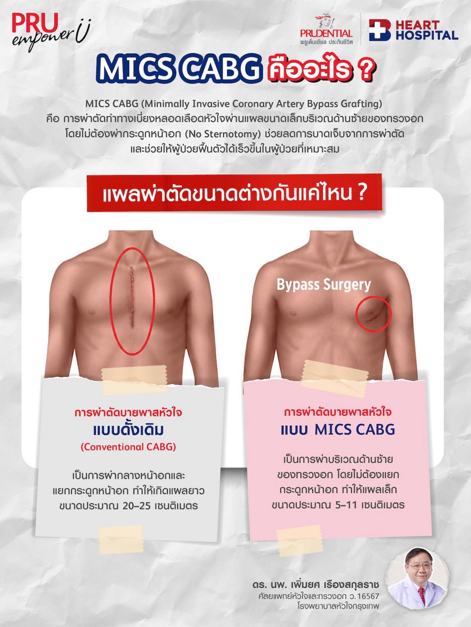 ผ่าตัดบายพาสแผลเล็ก คืออะไร กี่วันหาย