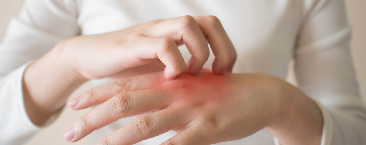 แสงแดดช่วยรักษาโรคผิวหนังอักเสบได้ไหม?