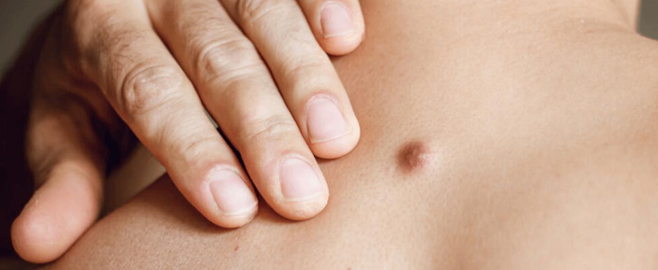 ก้อนมะเร็ง vs เนื้องอก ต่างกันยังไง?