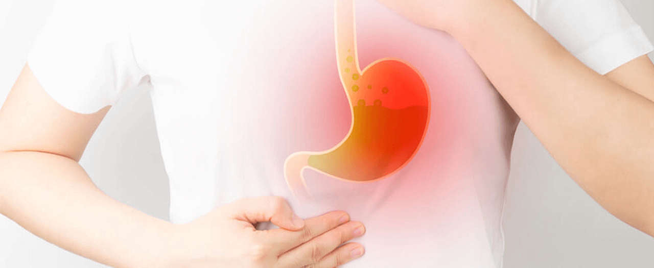 รู้ทันสาเหตุกรดไหลย้อน อาการ แนวทางการรักษา และวิธีป้องกัน