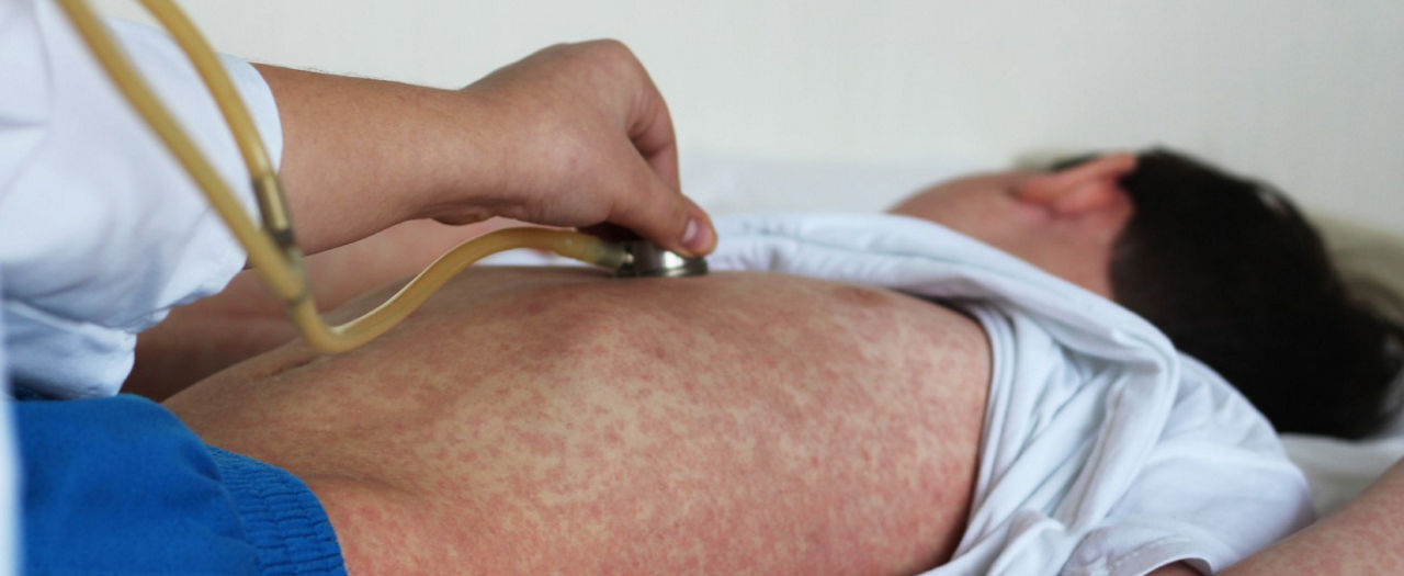 Cách phân biệt sởi và sốt phát ban để điều trị kịp thời
