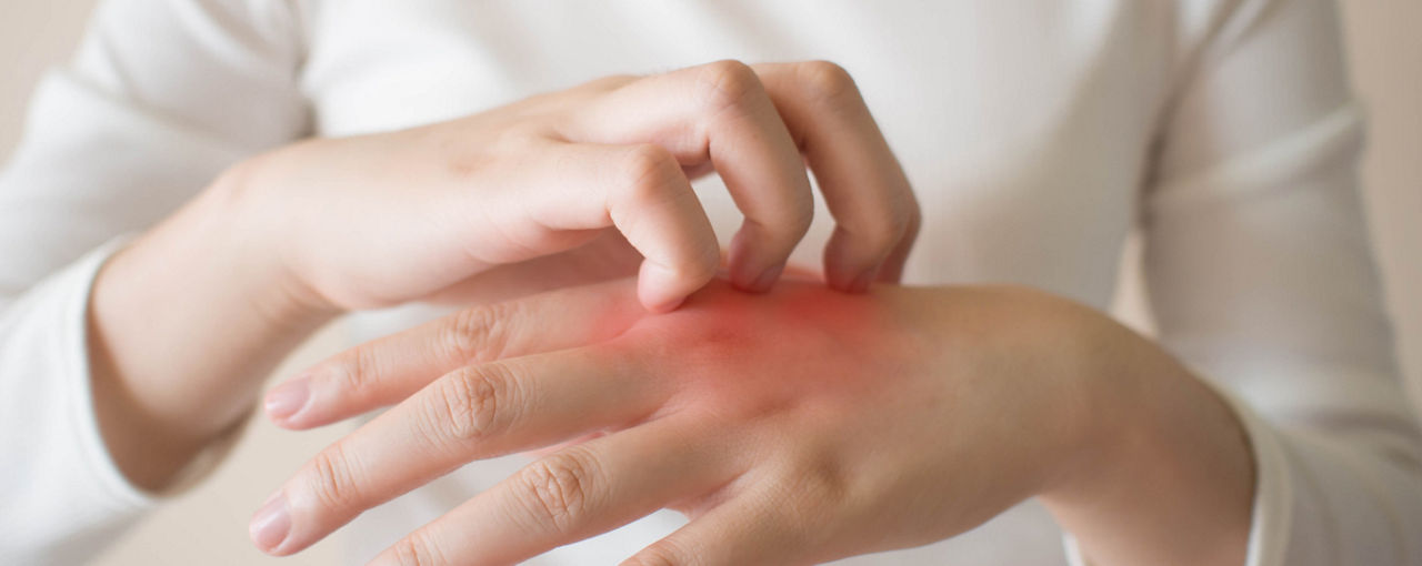 แสงแดดช่วยรักษาโรคผิวหนังอักเสบได้ไหม?