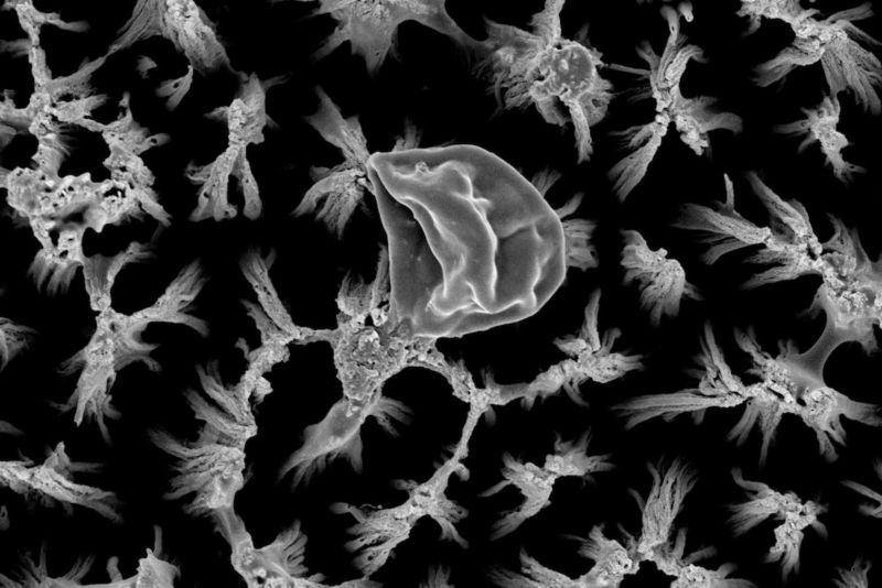 Một tế bào Candida bị vỡ trên bề mặt titan có gai siêu nhỏ, phóng đại 25.000 lần. 