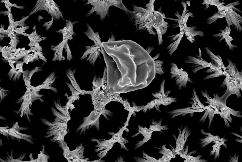 A ruptured Candida cell on top of the micro-spiked titanium surface, magnified 25,000 times.